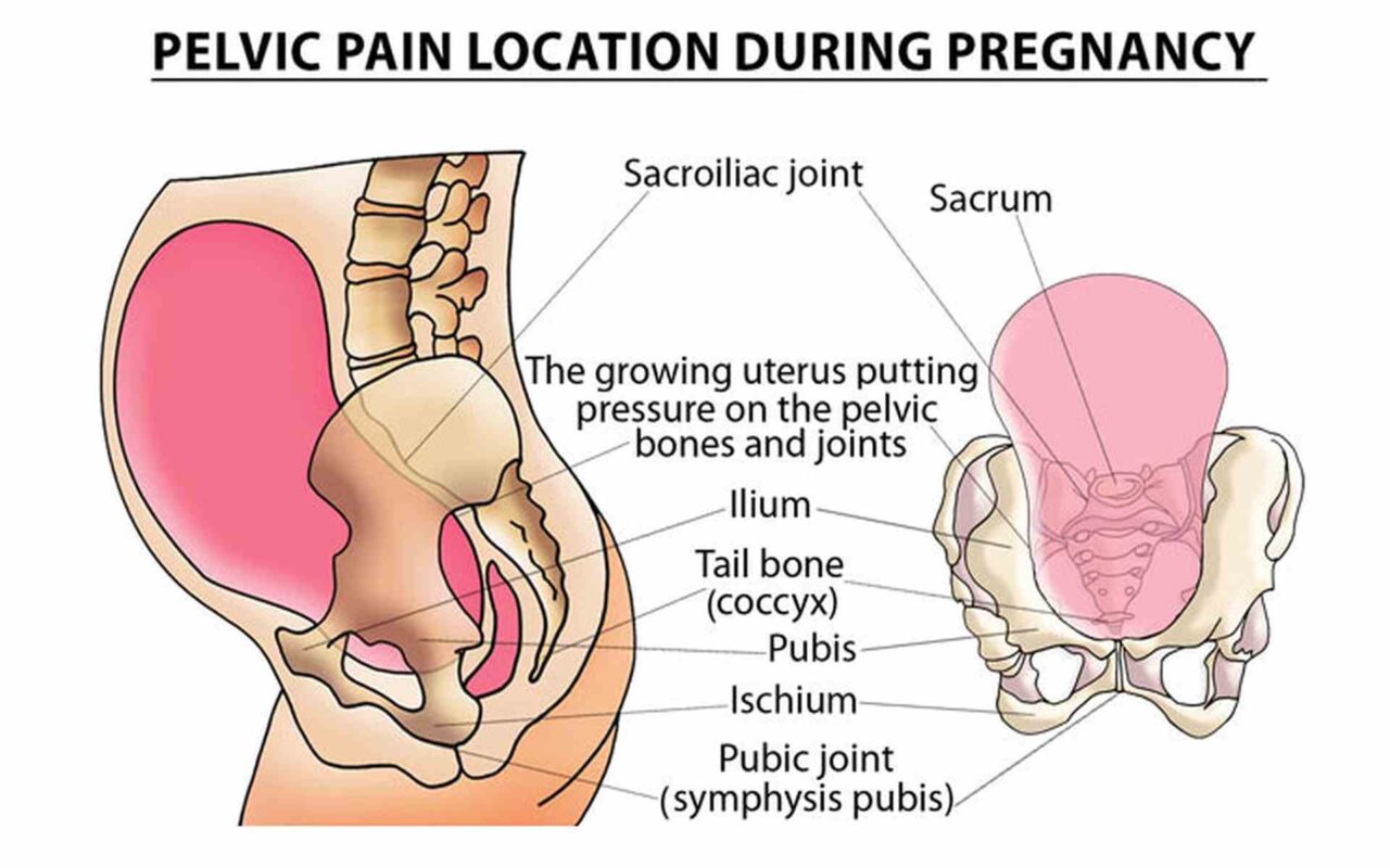 Pelvic Floor Dysfunction During Pregnancy: Causes, Symptoms, and Relief Options